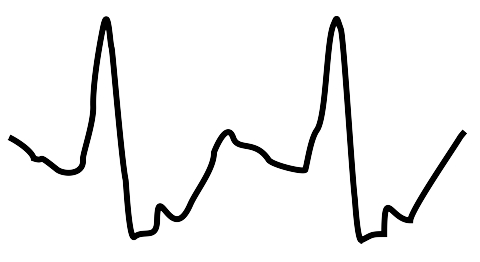 HDCVi signal 1